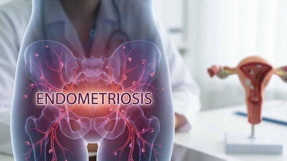 Il 28 marzo è la Giornata mondiale dell’endometriosi